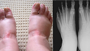 Har du opsvulmede fødder? Det kan være tegn på en alvorlig sygdom. Nedenfor præs